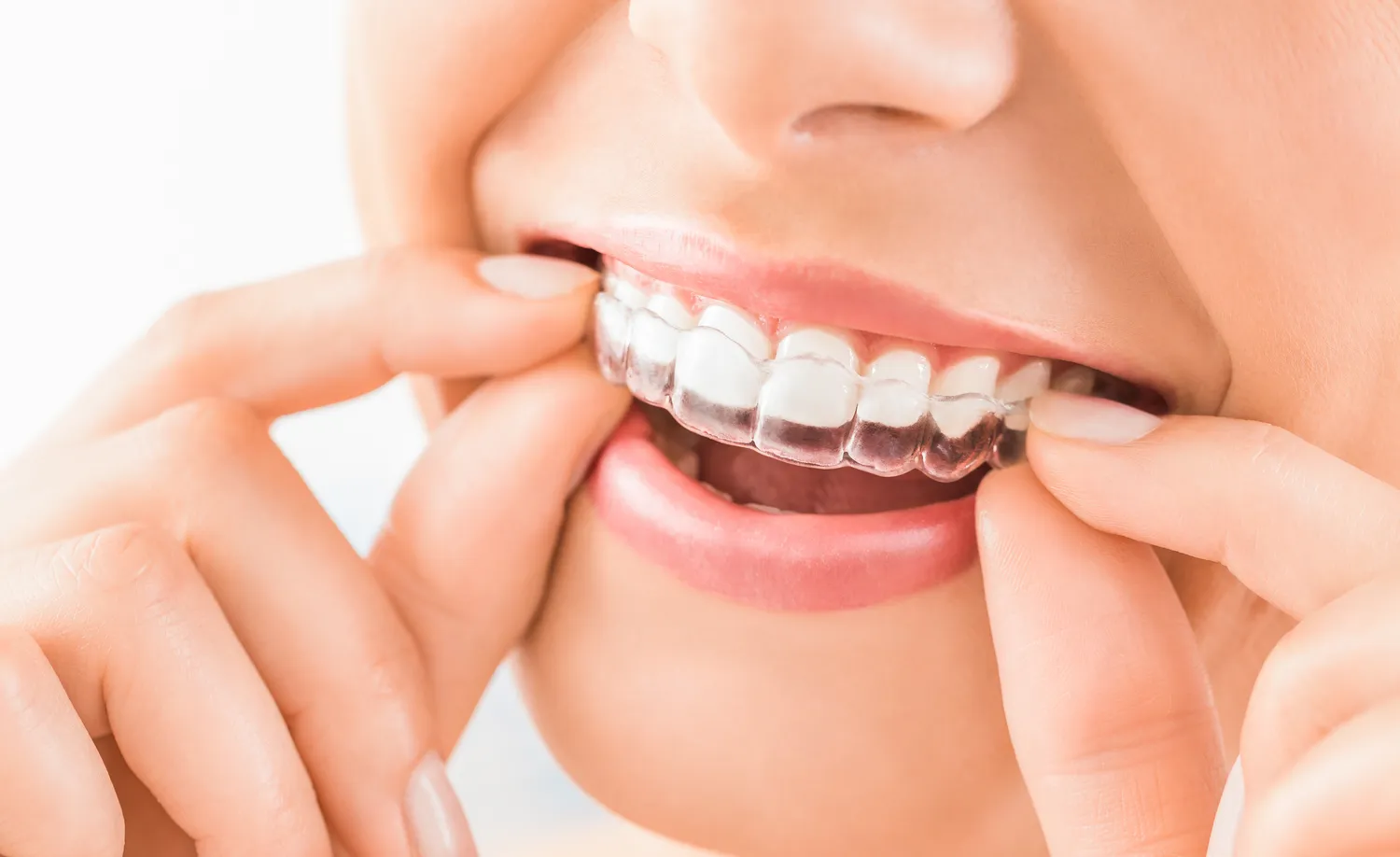 Invisalign Lublin