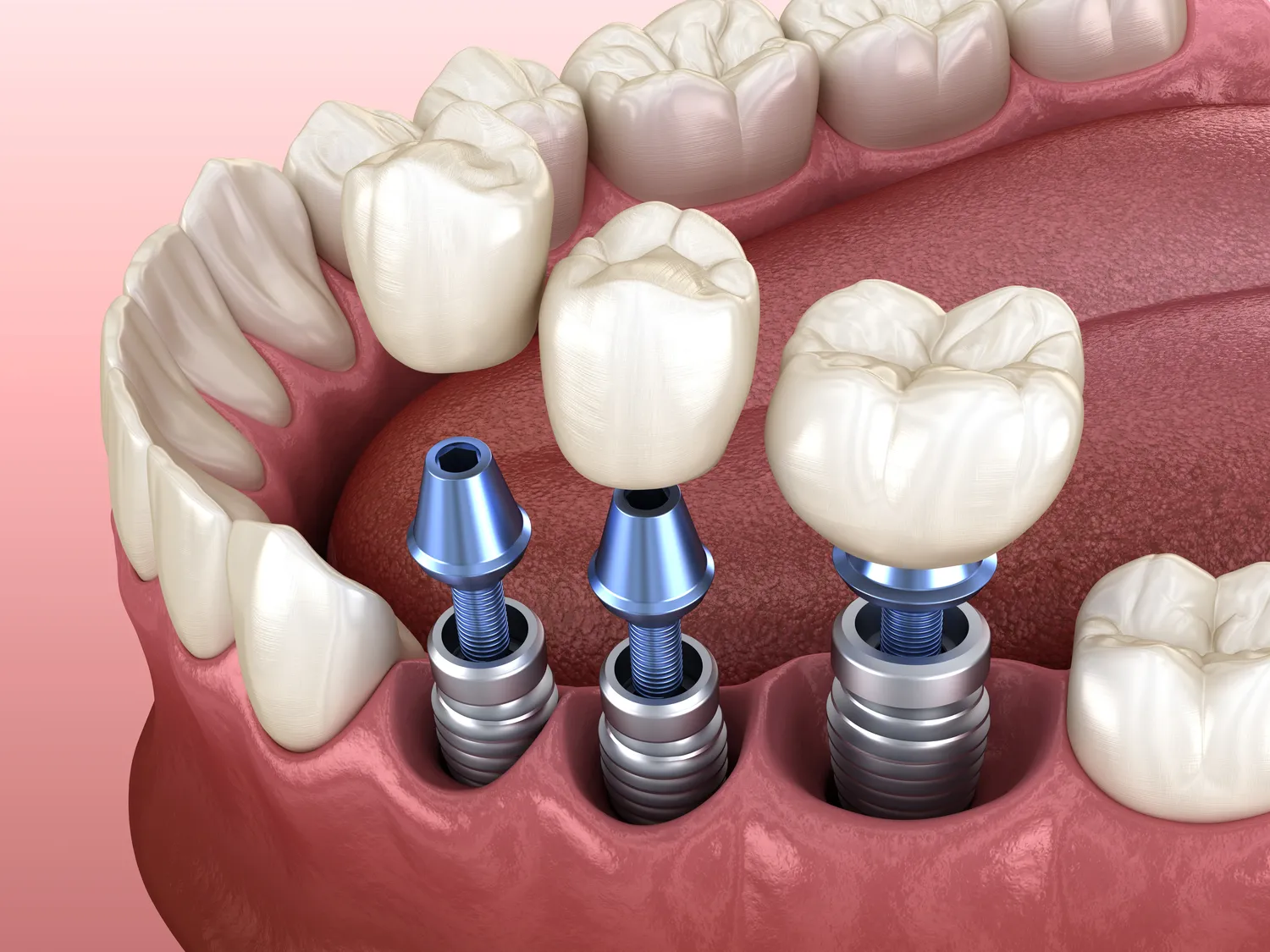 Dentysta Warszawa implanty